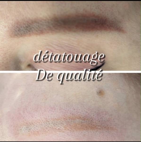 avant/après détatouage sourcil 